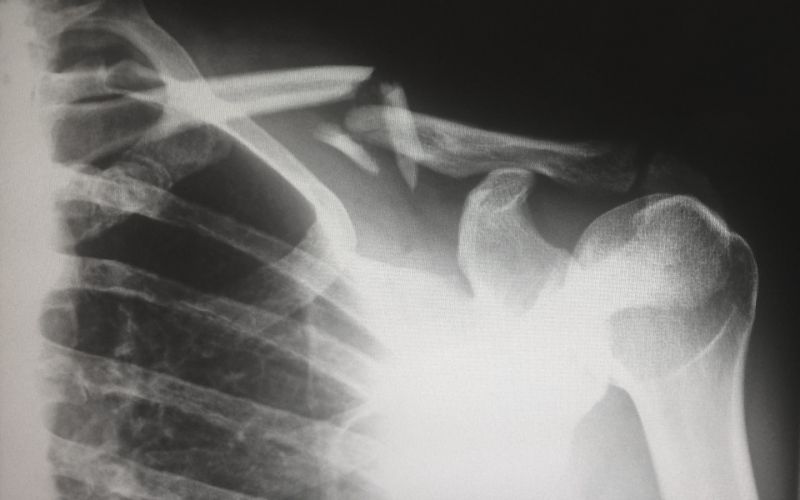 Röntgen eines Knochenbruchs