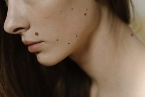 Muttermale Bedeutung Und Ihre Astro Geheimnisse